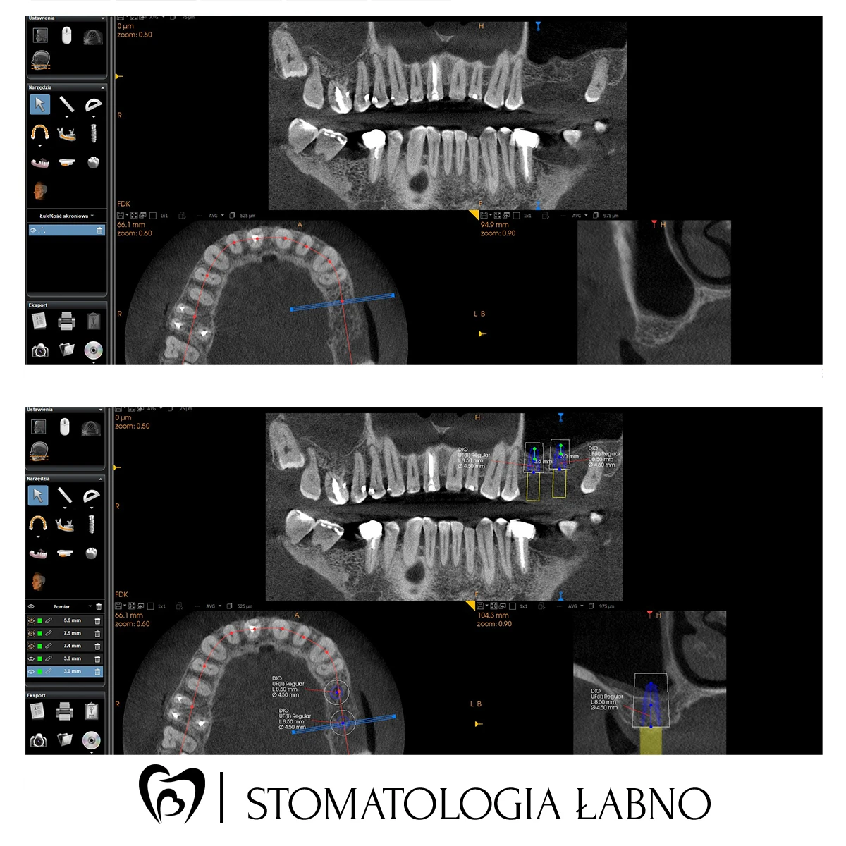 Przypadek leczenia w Stomatologii Łabno