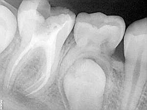 leczenie kanałowe gorlice stomatologia łabno