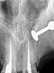 leczenie kanałowe gorlice stomatologia łabno